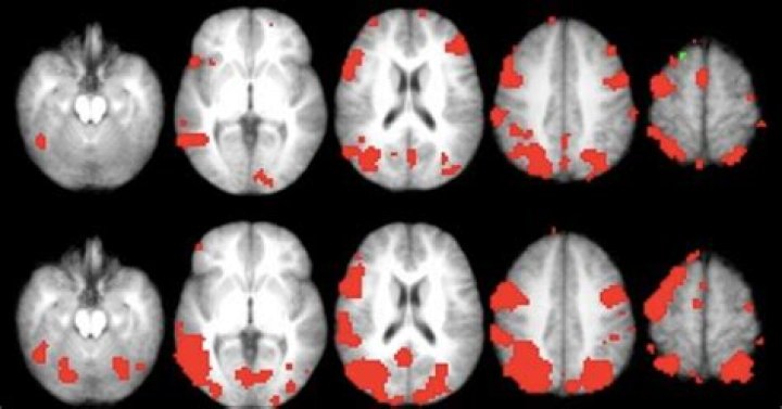 Are Forgotten memories still in your brain?