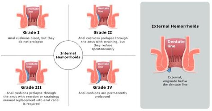 Can a hemorrhoid go away on its own?