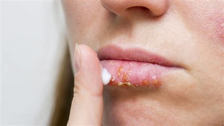 Can herpes be in the corner of your mouth?