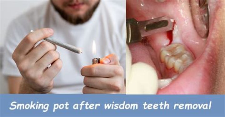 Can I smoke a week after wisdom teeth removal?