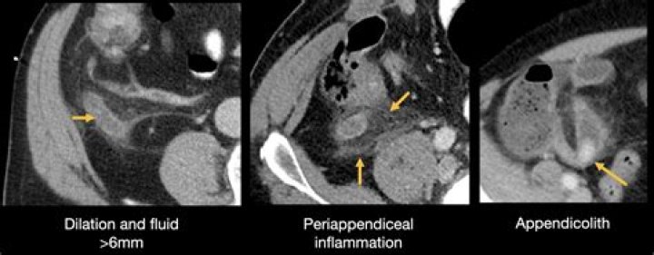 Can peritonitis kill you?