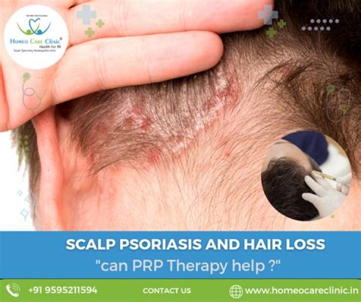 Can scalp psoriasis be cured?