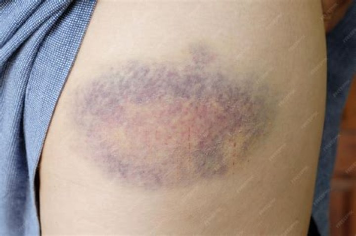 Do breast hematomas go away?