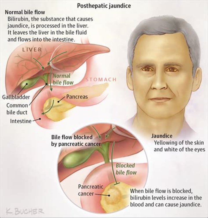 Does gallbladder cause jaundice?