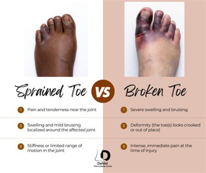 How can you tell if your toe is broken?