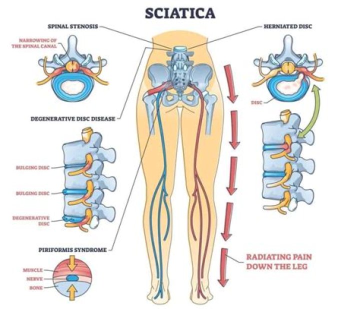 How do I know if it's my sciatic nerve?