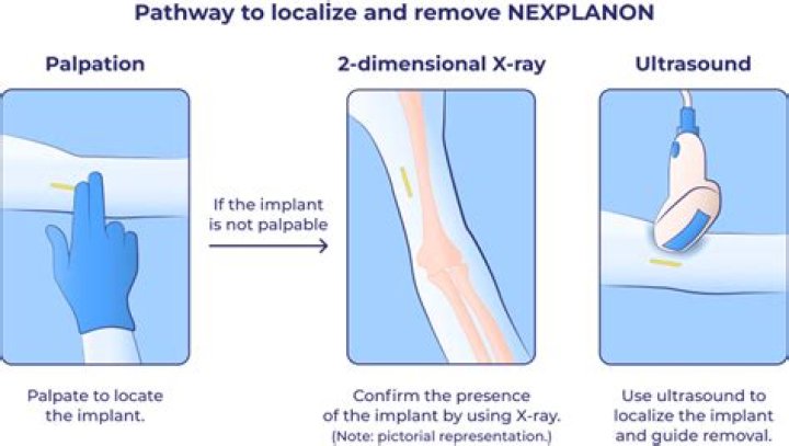 How do you take care of your arm after nexplanon removal?