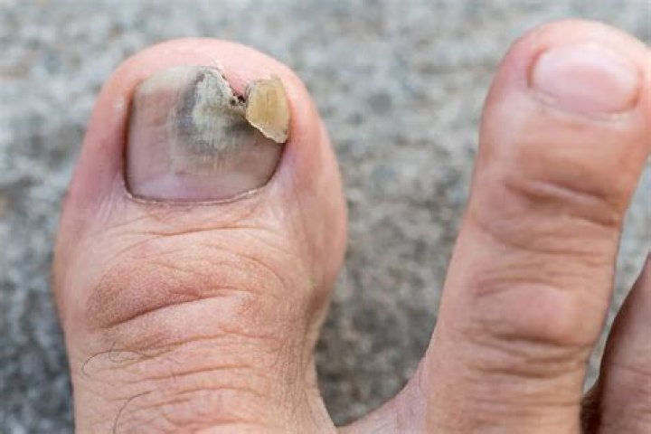 How do you treat a blister under your toenail?