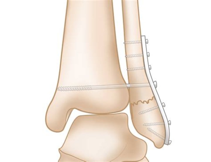 How long does it take for lateral malleolus fracture to heal?