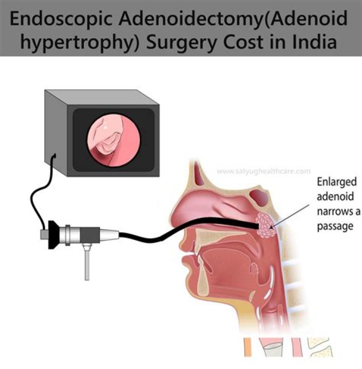 How much does adenoid surgery cost?