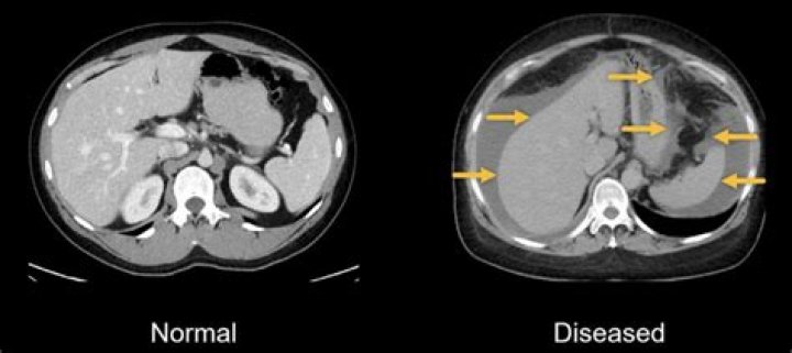 Is a soft abdomen normal?