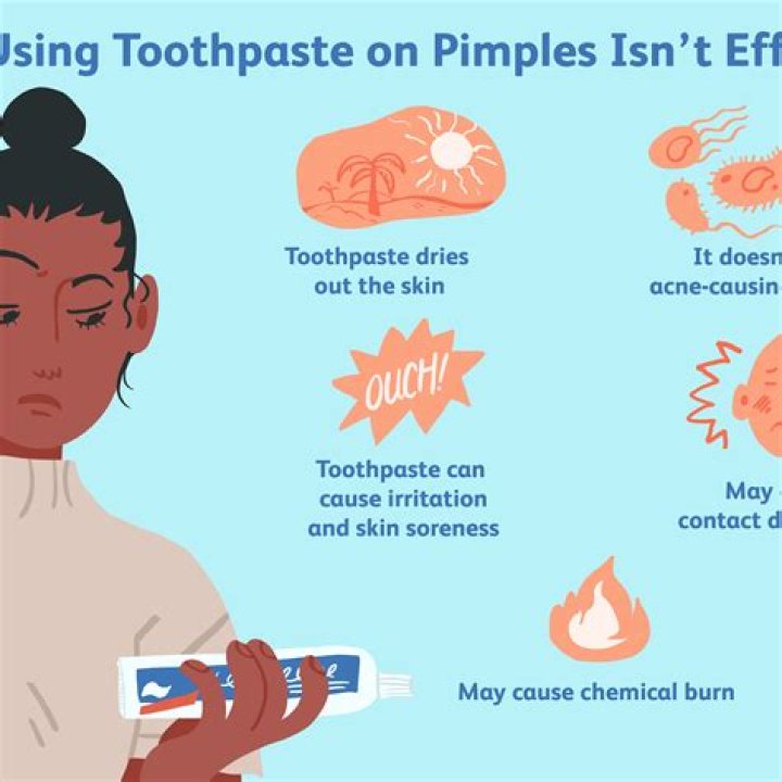 Is it supposed to burn when you put toothpaste on a pimple?