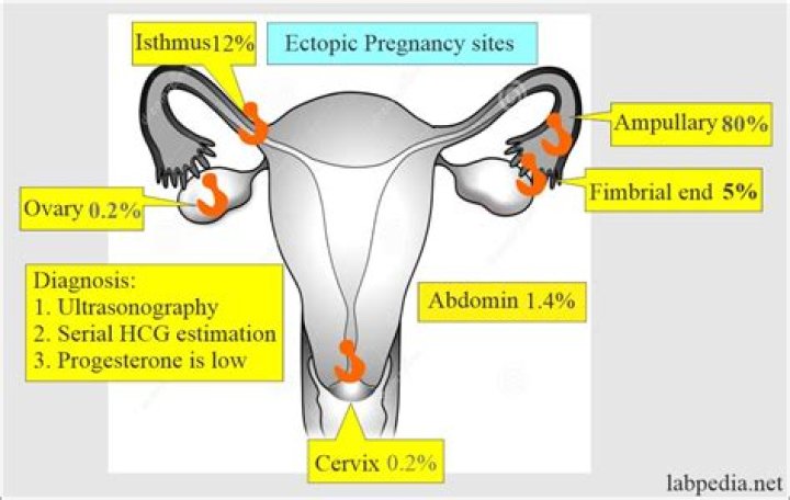 What are the sites of ectopic pregnancy?
