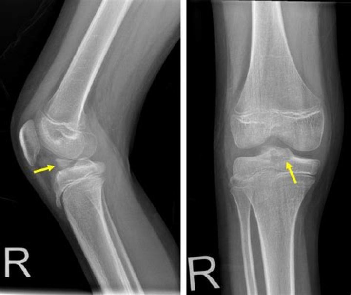 What is an avulsion fracture of the knee?