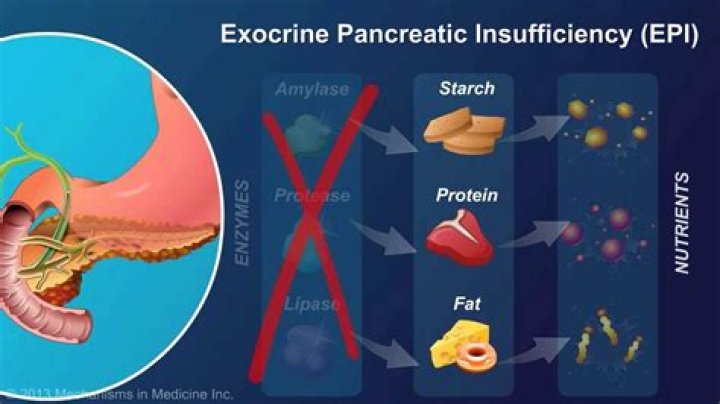 What is exocrine pancreatic insufficiency?
