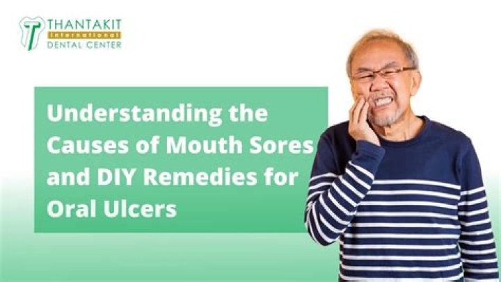 What is good for mouth ulcers?