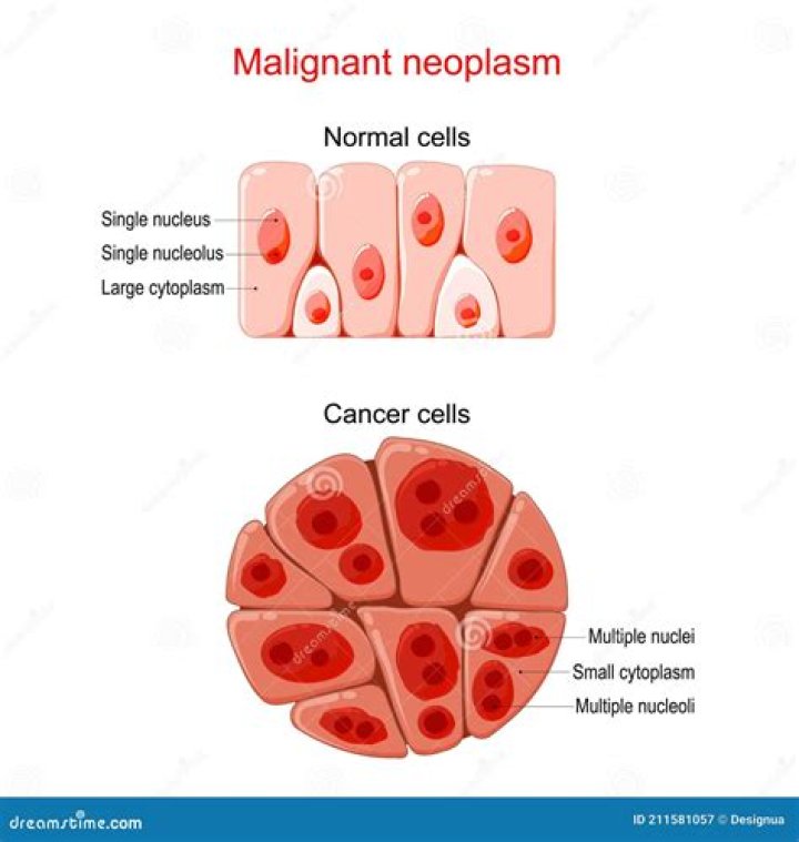 What is malignant neoplasm of prostate mean?