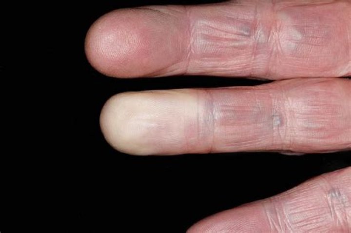 Why do my fingers turn yellow from smoking?
