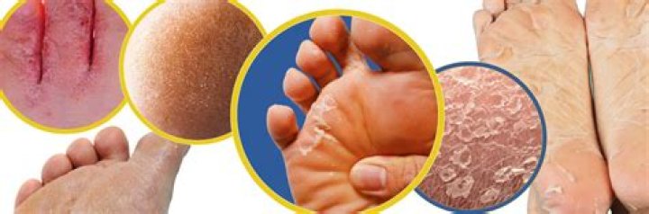 Why is the skin peeling off my feet?